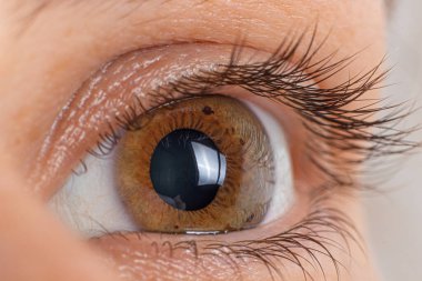 Makro göz fotoğrafı. Keratoconus 2 derece - göz hastalığı, koni şeklinde kornea incelmesi. Kornea plastiği..