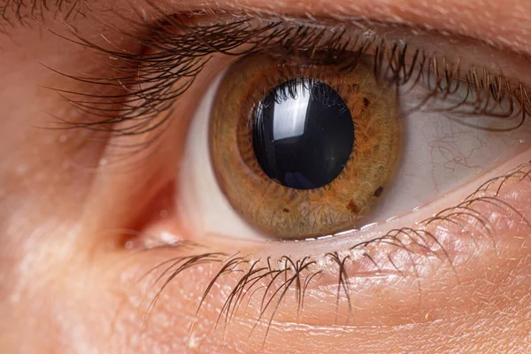 Makrooční Foto Keratoconus Oční Onemocnění Ztenčení Rohovky Podobě Kužele Plastová — Stock fotografie