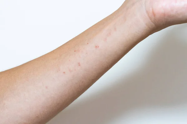 Foto Primo Piano Eczema Lieve Una Parte Corpo Maschile Adulto — Foto Stock