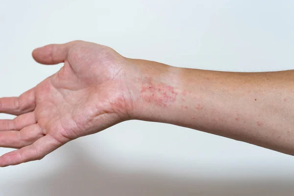 Foto Close Eczema Leve Uma Parte Corpo Masculino Adulto — Fotografia de Stock