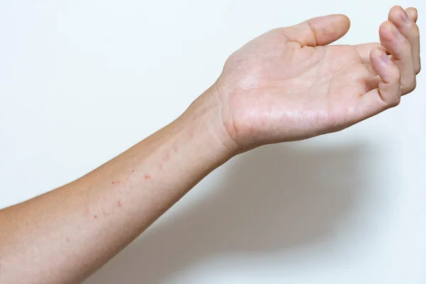 Close Photo Mild Eczema Part Adult Male Body — Stock Photo, Image