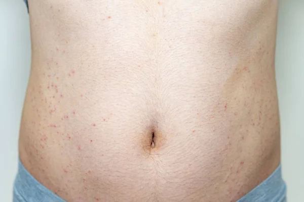 Foto Primo Piano Eczema Lieve Una Parte Corpo Maschile Adulto — Foto Stock