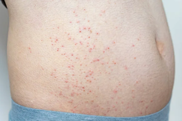 Foto Primo Piano Eczema Lieve Una Parte Corpo Maschile Adulto — Foto Stock