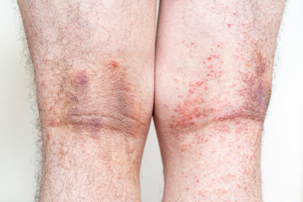 Severe eczema with pus (adult male leg)