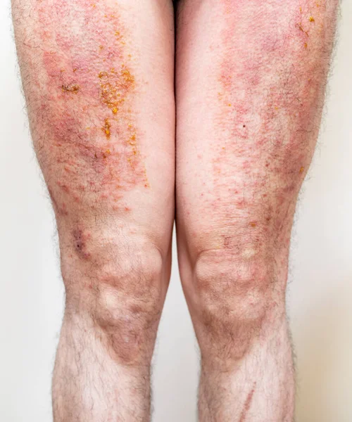 Eczema Grave Con Pus Gamba Maschile Adulta — Foto Stock