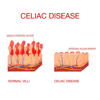 Coeliac hastalığı ya da çölyak hastalığı. Sağlıklı ve hasarlı villi.