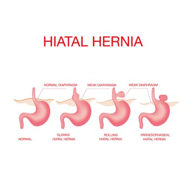 Hiatal hernia. Hiatal hernia and normal anatomy of the stomach clipart