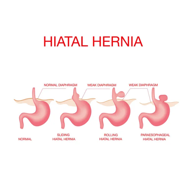 Hernie hiatale. Hernie hiatale et anatomie normale de l'estomac — Image vectorielle