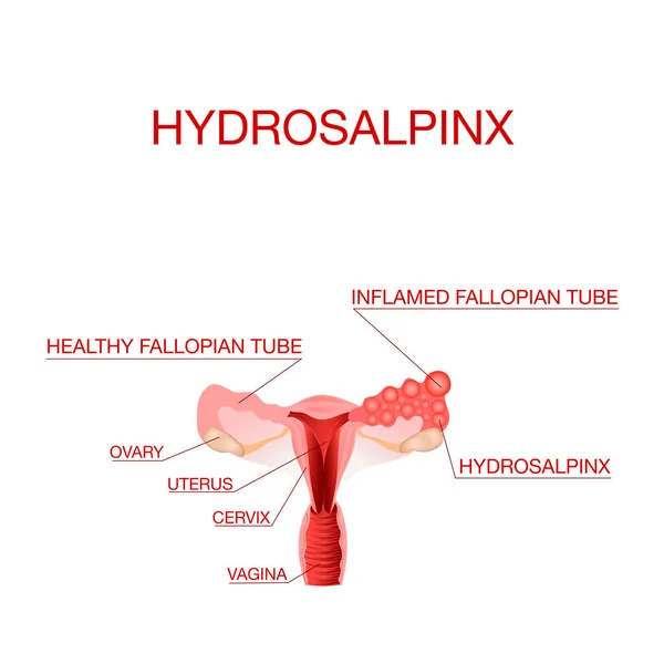 Hydrosalpinx.Anatomie Realistické barevné ilustrace.Gynekologické hydrosalpinx informace Infographics — Stockový vektor