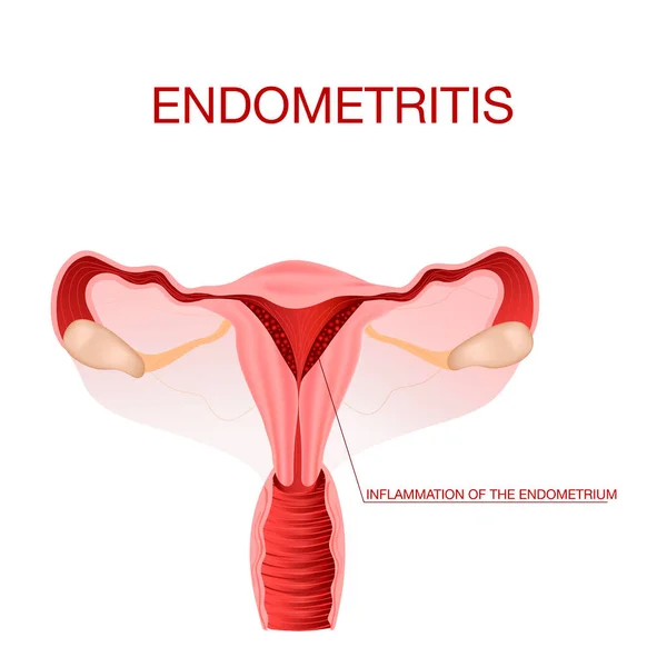 Endometritis inflamación del útero.Inflamación del endometrium.Vector ilustración — Vector de stock