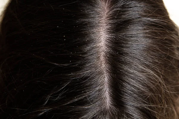 Cabello Oscuro Con Caspa Chica Pasa Través Pelo Con Sus — Foto de Stock