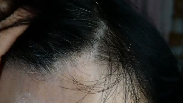 Mujer Adulta Madura Quita Pelo Frente Cabello Gris Alopecia Piel — Vídeos de Stock