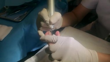 Chiropodist were gloves use use electric pen type polishing machine for polish toenail to smooth and clean under the lamp. Healthcare and medical concept footage.
