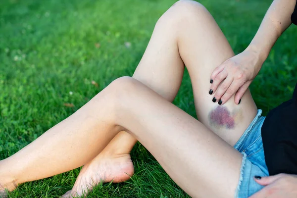 Woman Large Purple Bruise Her Leg Sits Grass Park Post — Stock Photo, Image