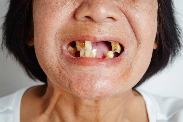 Una Anciana Asiática Sonrió Vio Los Dientes Restantes Boca Debido — Foto de Stock