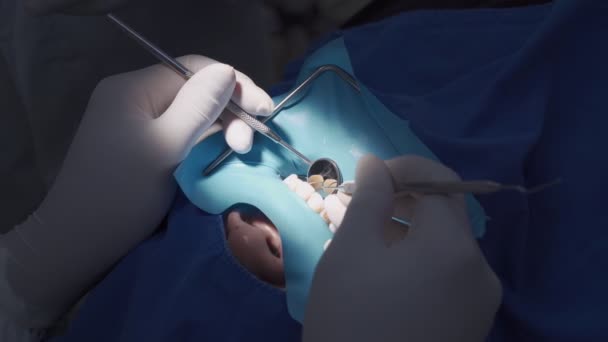Closeup Dental Operation Dentist Examining Patient Tooth Dental Chair Dentist — Stock Video