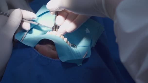 Close Tandarts Opereren Patiënt Dragen Witte Beschermende Handschoenen Apparatuur Gereedschap — Stockvideo
