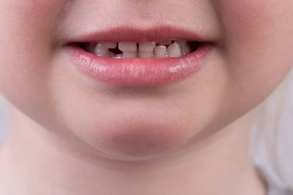 Smile Little Cute Girl Lost Baby Tooth Close — Stock Photo, Image