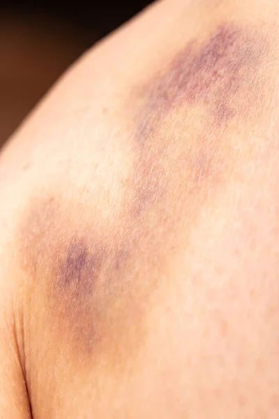 女性の皮膚の血腫 — ストック写真