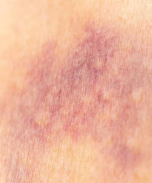 女性の皮膚の血腫 — ストック写真
