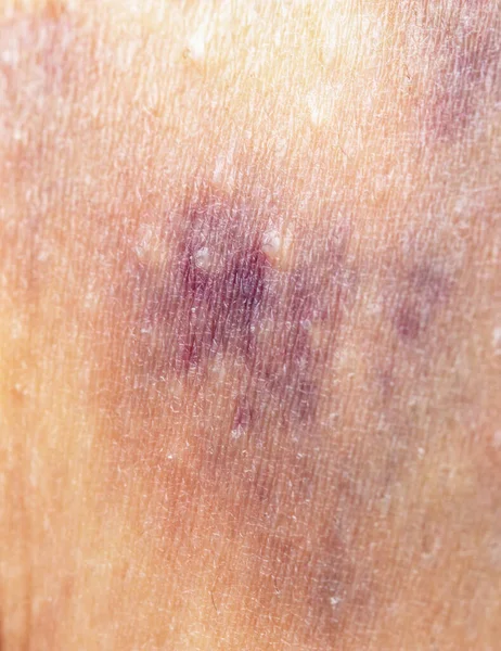 Hematoma Female Skin — Stock Photo, Image