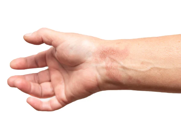 Термічний Опік Шкіри Руці — стокове фото
