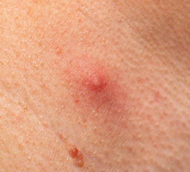 Arkaplan olarak cilt üzerinde sivilce