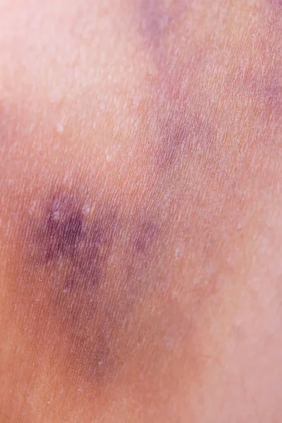 Hematoma Skin Legs — Stock Photo, Image