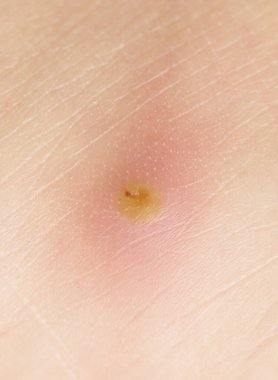 Derisinde iltihap olan apse.