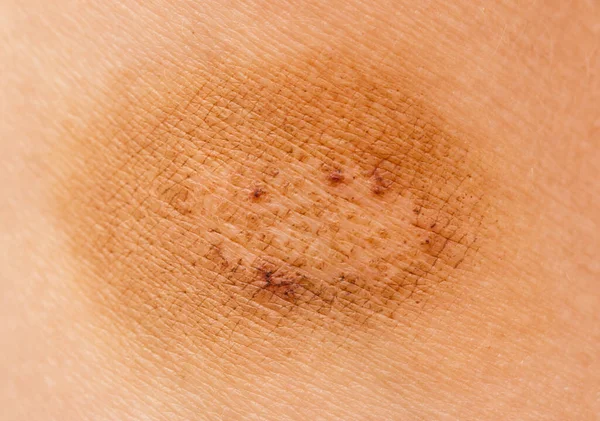 Birthmark Skin Background — Stock Photo, Image
