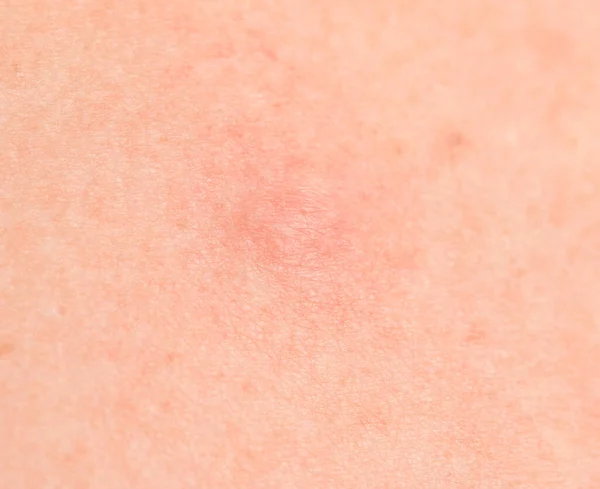 Red Spots Skin Sun — Stock Photo, Image