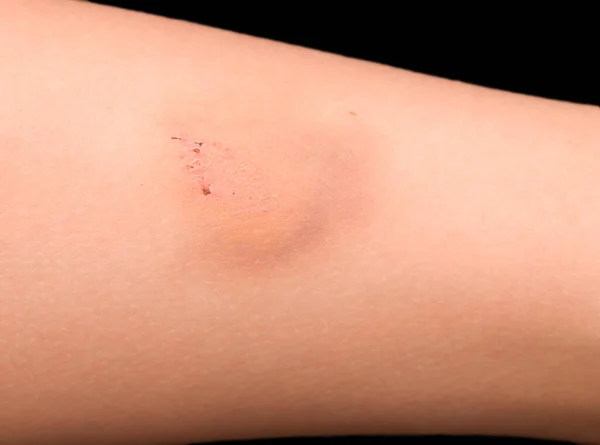 Bruise Leg Scratch — Stock Photo, Image
