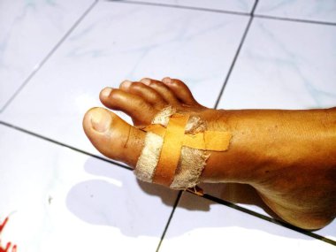 Adamın bacağındaki kanayan yara bandajlarla kaplıydı. Yara bakımı için yama. Güvenlik. Acı.