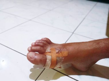 Adamın bacağındaki kanayan yara bandajlarla kaplıydı. Yara bakımı için yama. Güvenlik. Acı.