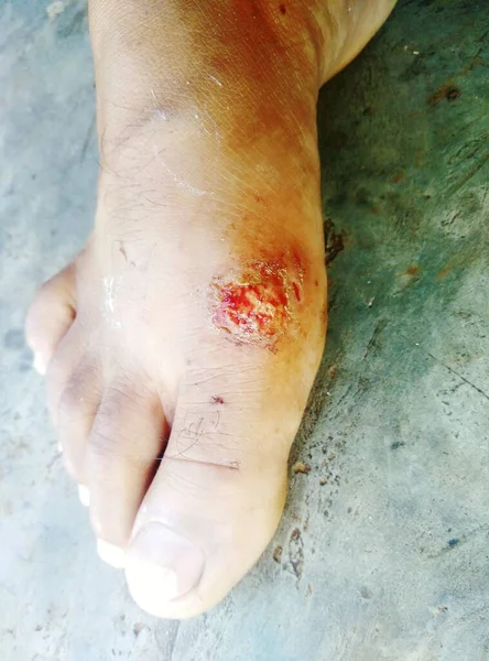 Кроваво Красные Ноги Порвал Свои Черные Штаны Потому Упал Мотоцикла — стоковое фото