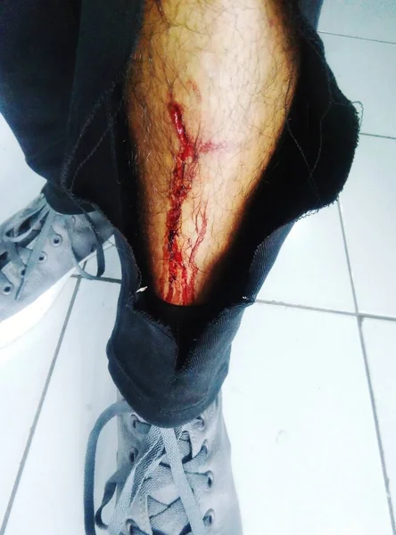 Кроваво Красные Ноги Порвал Свои Черные Штаны Потому Упал Мотоцикла — стоковое фото