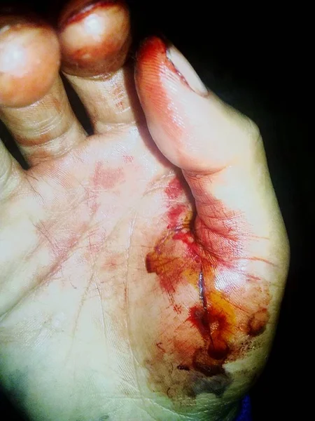 一个人的手被割开了 用红血绷带包扎 因为被割破的刀非常锋利 — 图库照片