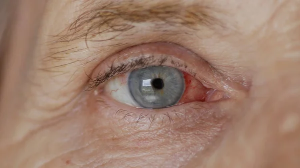 Close up. elderly woman eye with burst capillaries, cataract surgery — Stock Photo, Image