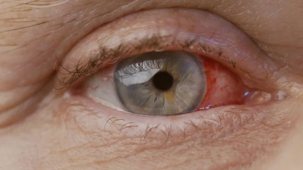 De près. oeil de femme avec des brûlures chimiques de la cornée. capillaires éclatés, chirurgie de la cataracte — Photo