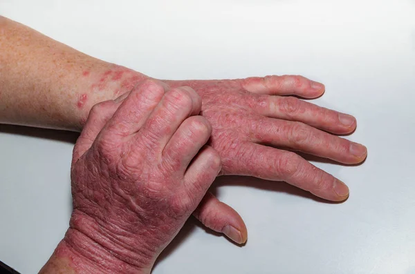 Psoriasispatient Kliar Sig Händerna Klåda Huden Med Kroniska Dermatoser Psoriasis — Stockfoto