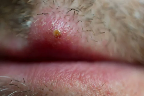 Herpes on the upper lip of a man. Macro. Soft focus, shallow depth of field