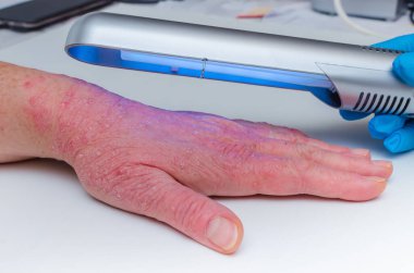 Fototerapi dermatozisi. Cilt hastalıklarının tedavisi - sedef, ekzemi, dermatit, dar bantlı ultraviyole radyasyon.