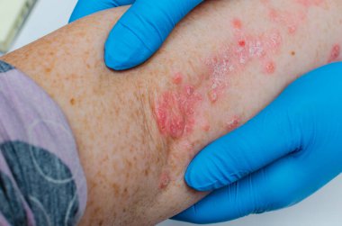 Deri hastalıklarının teşhisi - alerji, sedef, egzama, deri iltihabı. Eldivenli bir dermatolog hasta bir hastanın dirseğini muayene eder..