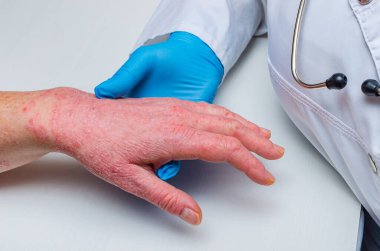 Eldivenli doktor hasta bir hastanın derisini muayene ediyor. Kronik deri hastalıkları - sedef, egzama, dermatit.