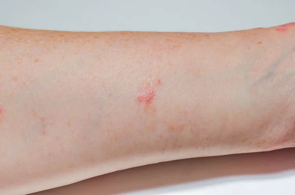 Allergiska Hudutslag Underarmens Insida Psoriasis Atopisk Dermatit Eksem Hudmanifestationer Hudproblem — Stockfoto