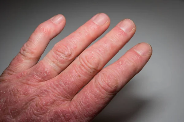 Hand Psoriasispatient Närbild Psoriasisartrit Leddeformation Och Inflammation Huden Foto Med — Stockfoto