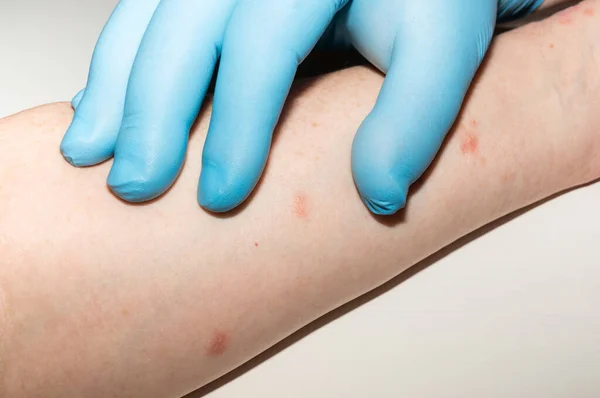 Ön kolun iç yüzeyinde alerjik deri kızarıklığı. Tıbbi muayene. Deri sorunlarının teşhisi. Sedef hastalığı, atopik dermatit, egzama..