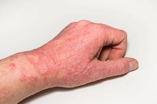 Lesiones Cutáneas Alérgicas Mano Con Grietas Inflamación Descamación Psoriasis Dermatitis Fotos de stock libres de derechos
