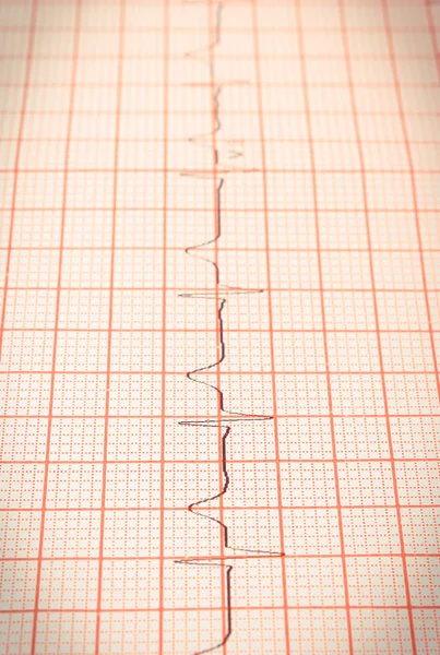 График Электрокардиограммы Например Сердечный Ритм Концепция Здравоохранения Медицины — стоковое фото