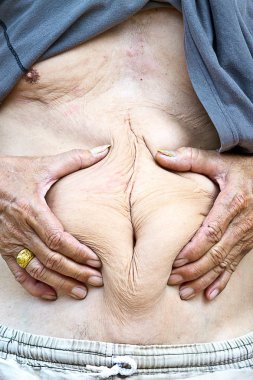 Yaşlı adam Belly düğmesi etrafında göbek yağ sıkıyor